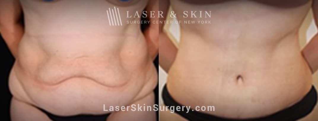 lsscny-nyc-tummy-tuck-before-and-after LSSCNY Ultherapy Treatment New York City, NY