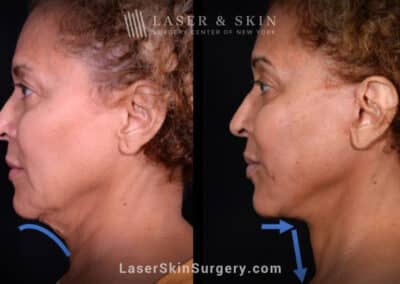 Facelift to rejuvenate the face and neck