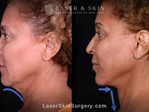 Facelift to rejuvenate the face and neck