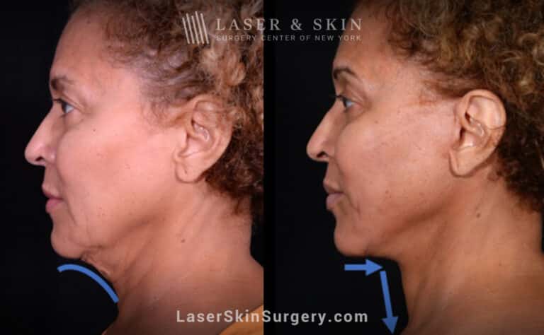 Facelift to rejuvenate the face and neck