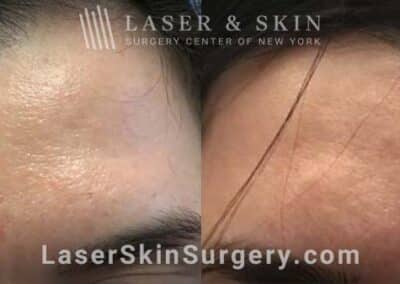 Excel V to Remove Telangiectasia from Forehead