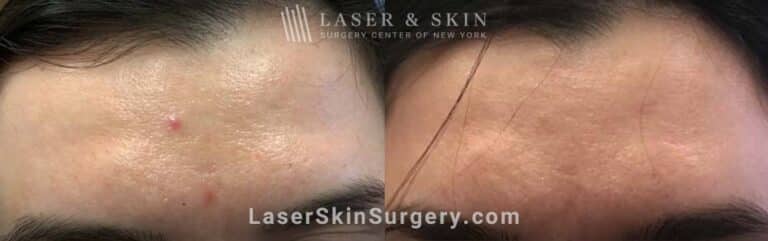 Excel V to Remove Telangiectasia from Forehead