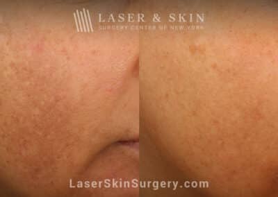 Clear + Brilliant Laser to Remove Brown Spots