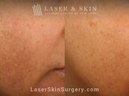 Clear + Brilliant Laser to Remove Brown Spots