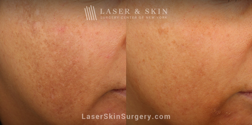 lsscny-nyc-jordan-wang-md-clear-and-brilliant-remove-brown-spots-1 skin discoloration before and after laser treatment