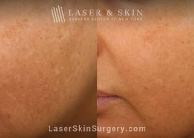 Clear + Brilliant Laser to Remove Brown Spots