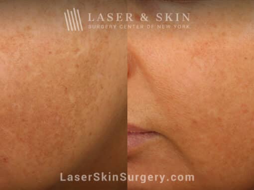 Clear + Brilliant Laser to Remove Brown Spots