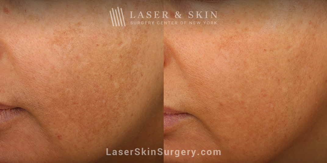lsscny-nyc-jordan-wang-md-clear-and-brilliant-remove-brown-spots-2 results of a sun damage treatment on the skin