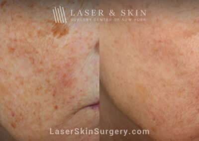 Clear + Brilliant Laser to Remove Brown Spots