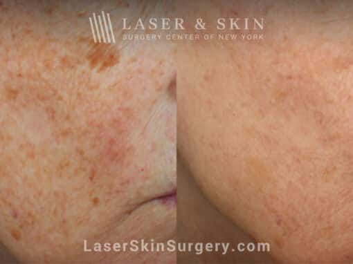 Clear + Brilliant Laser to Remove Brown Spots