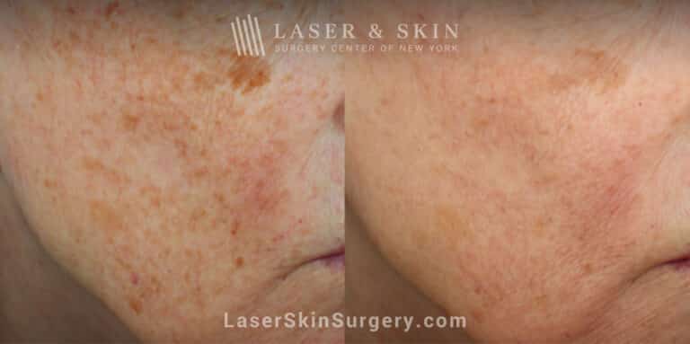 Clear + Brilliant Laser to Remove Brown Spots