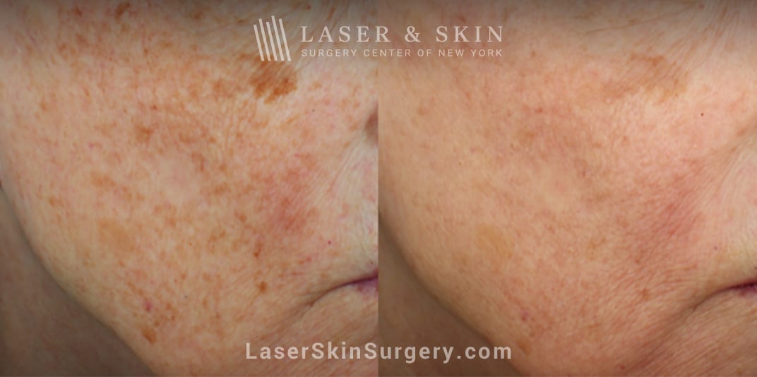 clear+brilliant skin tightening in new york