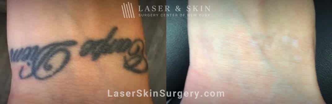 unwanted tattoo treatment results in NYC