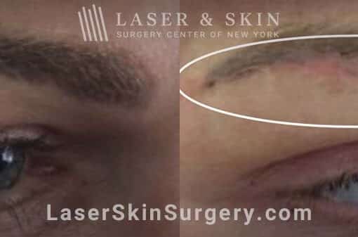 Picosecond Laser for Permanent Makeup Removal on Eyebrows