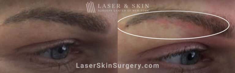 Picosecond Laser for Permanent Makeup Removal on Eyebrows