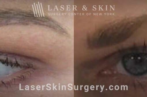 Permanent Makeup Removal on the Eyebrows with Picosecond Laser