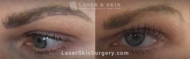 Permanent Makeup Removal on the Eyebrows with Picosecond Laser