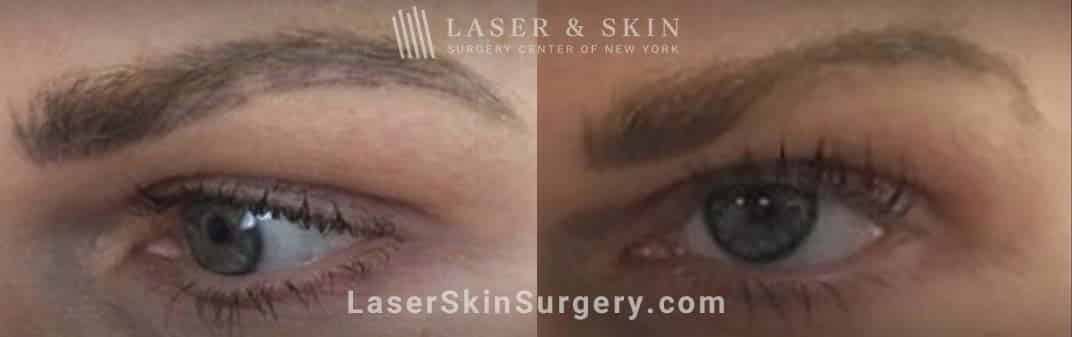 Permanent Makeup Removal on the Eyebrows with Picosecond Laser