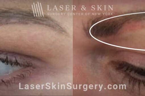 Picosecond Laser for Permanent Makeup Removal on Eyebrows