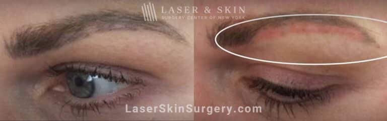 Picosecond Laser for Permanent Makeup Removal on Eyebrows
