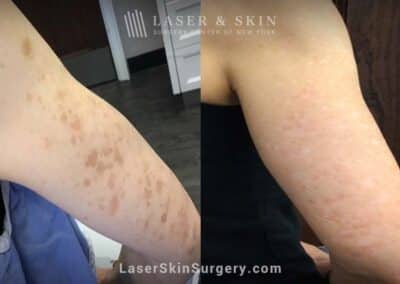 Ruby Laser to Treat Sun Spots on the Arms