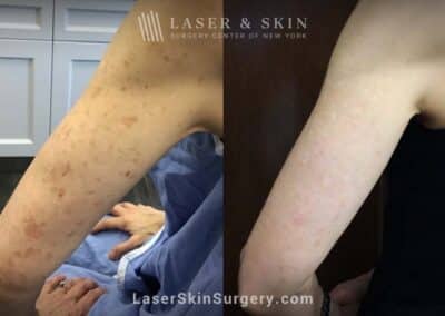 Sun Spot Treatments with the Ruby Laser