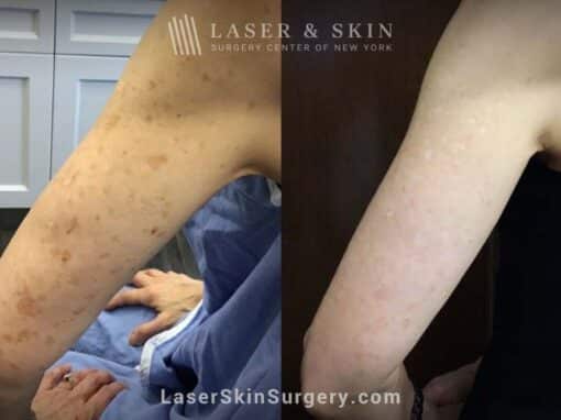 Sun Spot Treatments with the Ruby Laser