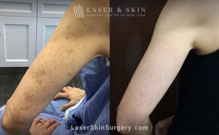 Sun Spot Treatments with the Ruby Laser