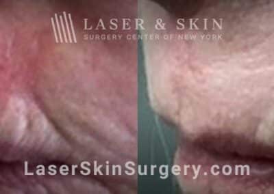Vbeam Pulsed Dye Laser to Treat Upper Lip Scarring