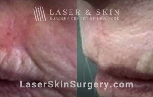 Vbeam Pulsed Dye Laser to Treat Upper Lip Scarring