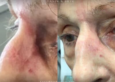Vbeam pulsed dye and erbium lasers to treat scar on the nose