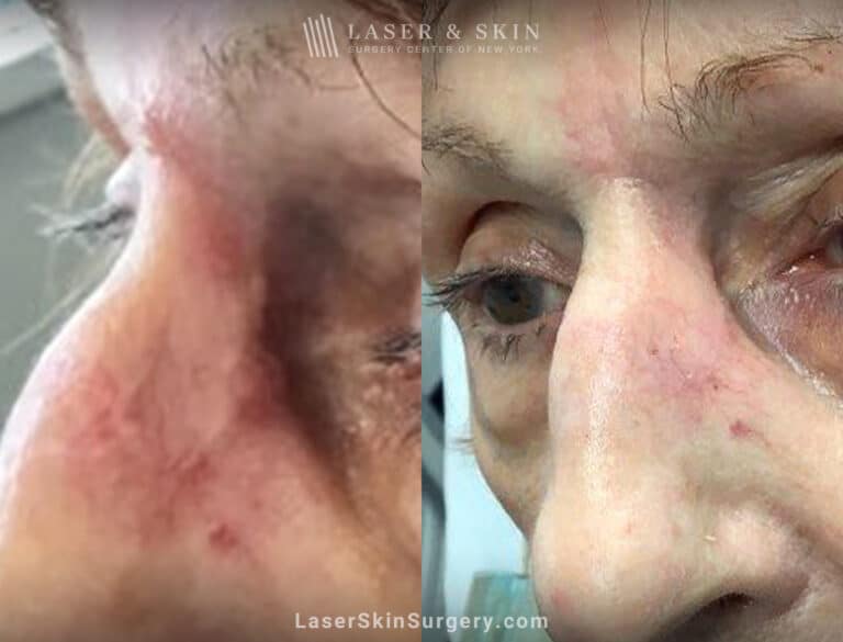 Vbeam pulsed dye and erbium lasers to treat scar on the nose