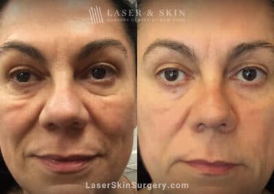 Genius Microneedling to Treat Festoons Underneath the Eyes