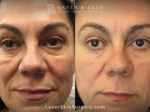 Genius Microneedling to Treat Festoons Underneath the Eyes