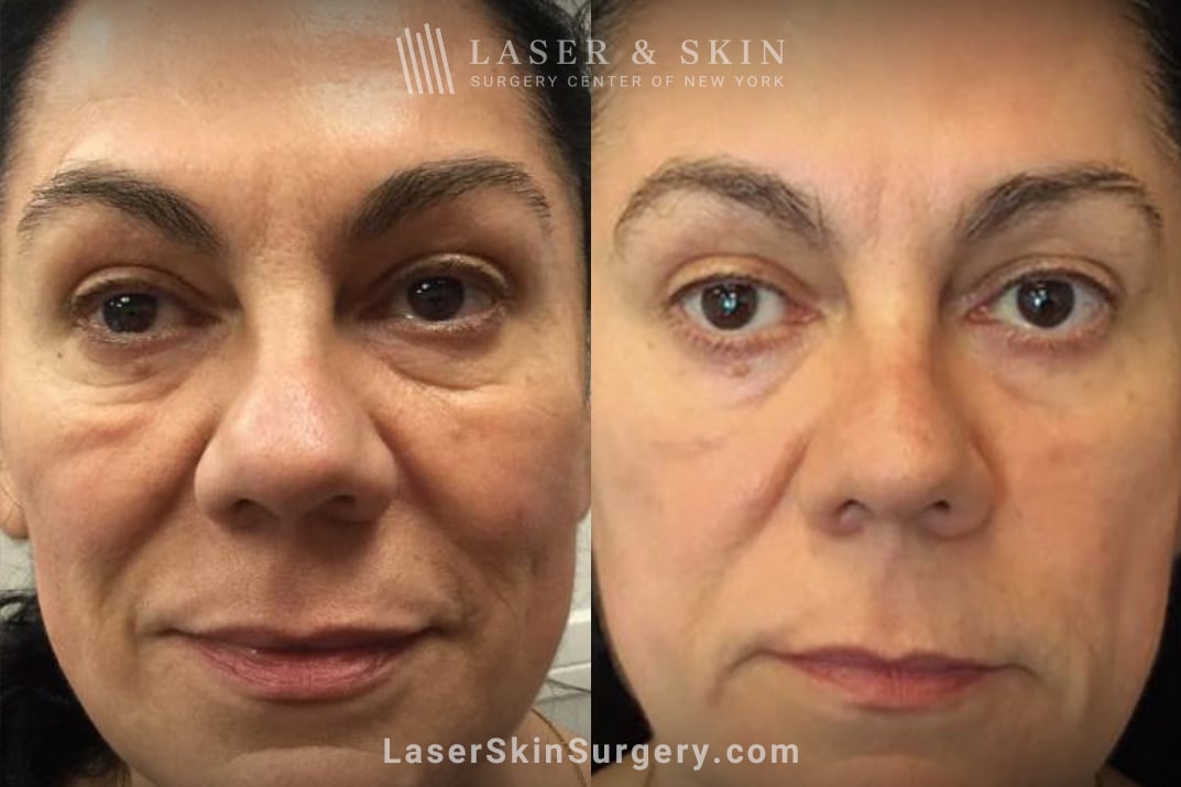 LSSCNY-festtoons-BA1-3-22-2022 Laser & Skin Surgery Center of NY Face shot of a female patient showing her face with melasma and the results after treatment, New York City, NY