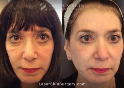 Genius Microneedling to Treat Festoons Underneath the Eyes