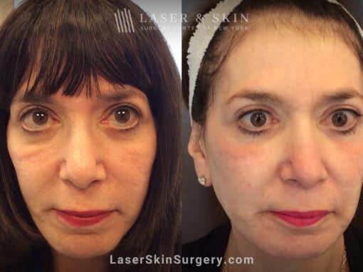 Genius Microneedling to Treat Festoons Underneath the Eyes