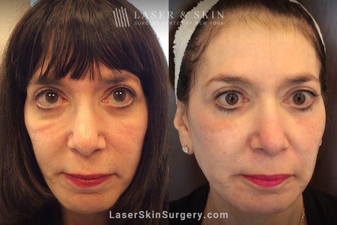 LSSCNY-festtoons-BA2-3-22-2022 Laser & Skin Surgery Center of NY Dr. Anolik with a patient during a consultation in NYC, NY