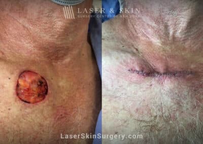 Mohs closure to treat skin cancer on the chest