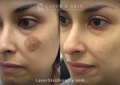 Q-switched nd:yag laser to treat birthmark on the cheek