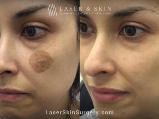 Q-switched nd:yag laser to treat birthmark on the cheek