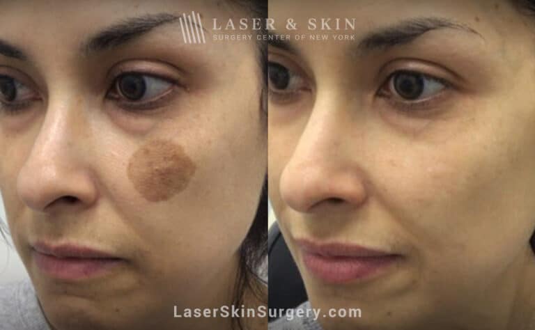 Q-switched nd:yag laser to treat birthmark on the cheek