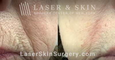Fraxel Repair laser to treatment wrinkles above the lips