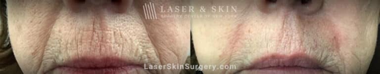 Fraxel Repair laser to treatment wrinkles above the lips