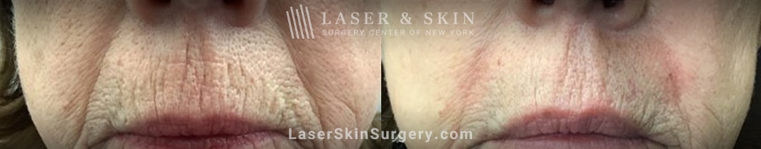 Fraxel Repair laser to treatment wrinkles above the lips