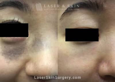 Q-switched Ruby laser to remove nevus of ota