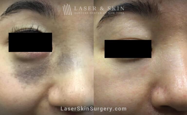 Q-switched Ruby laser to remove nevus of ota