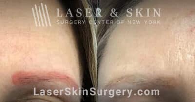 PicoPlus laser treatments to remove permanent makeup from eyebrows