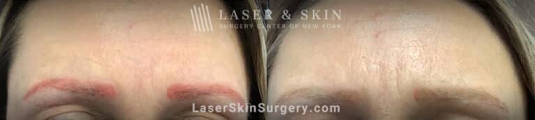 PicoPlus laser treatments to remove permanent makeup from eyebrows