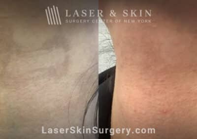 LaseMD to treat post-inflammatory hyperpigmentation